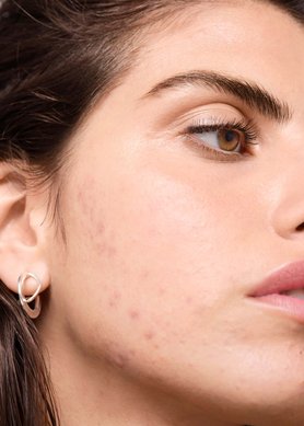 is-there-a-relationship-between-dairy-products-and-acne