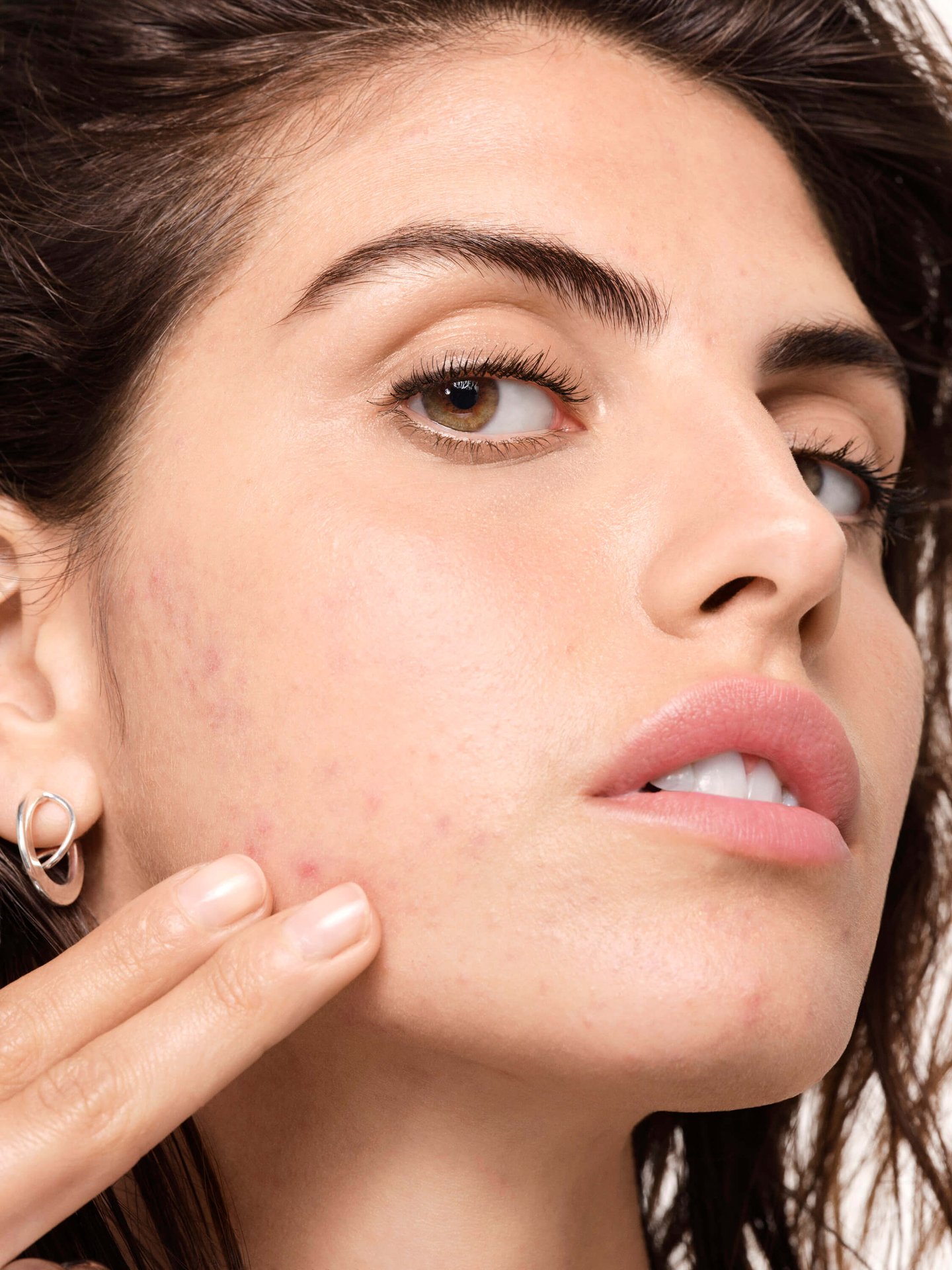 what-is-hormonal-acne-and-how-can-a-skincare-routine-help