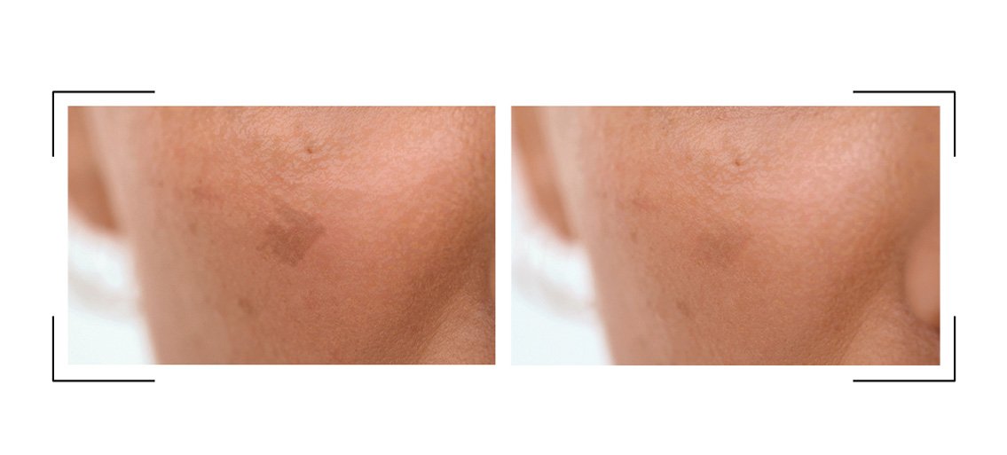 ¿Qué es bueno para las manchas de la cara?