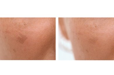 ¿Qué es bueno para las manchas de la cara?